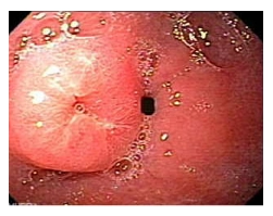 Nhiễm Histoplasmosis ở tá tràng