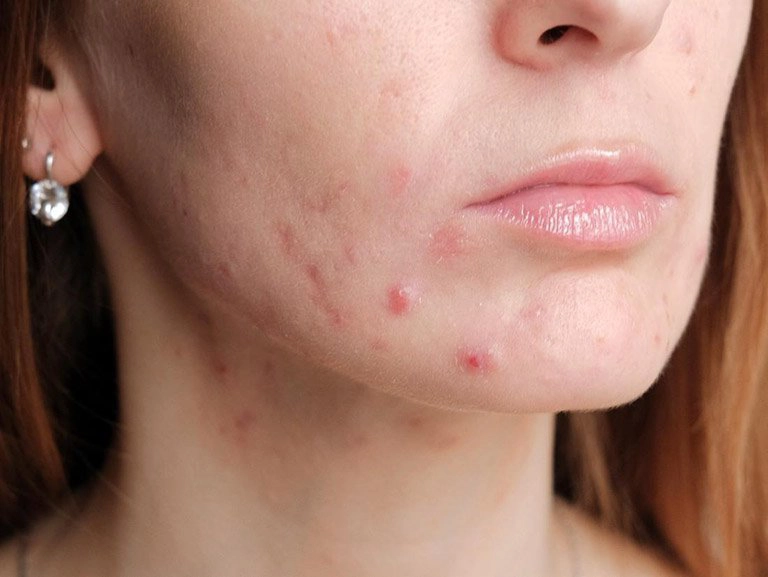 bệnh trứng cá đỏ