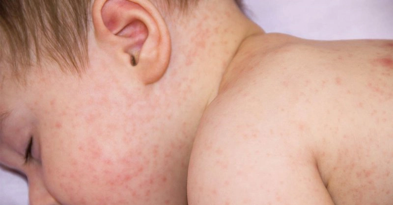 Sốt phát ban và sởi khác nhau như thế nào