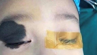u sắc tố bẩm sinh ở trẻ em