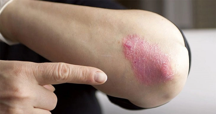 bệnh vảy nên mặc vải gì