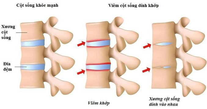 bệnh viêm cột sống dính khớp