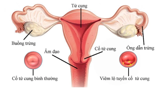 Viêm lộ tuyến