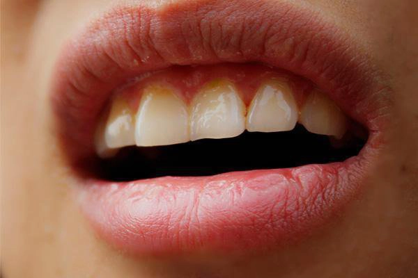 khô miệng mệt mỏi