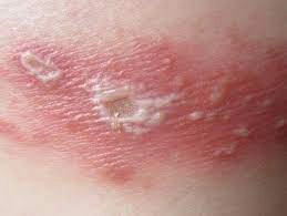 Bị kiến ba khoang cắn bôi thuốc gì