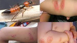 Bị kiến ba khoang đốt