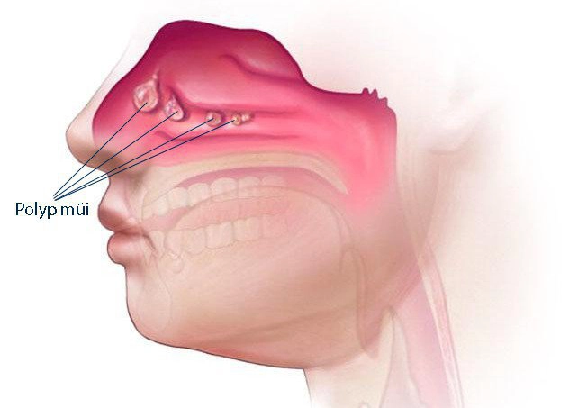 bị mất khứu giác