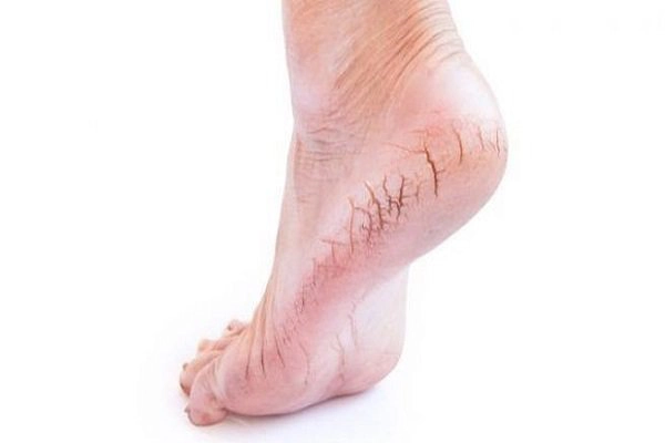 bị nứt gót chân là thiếu chất gì