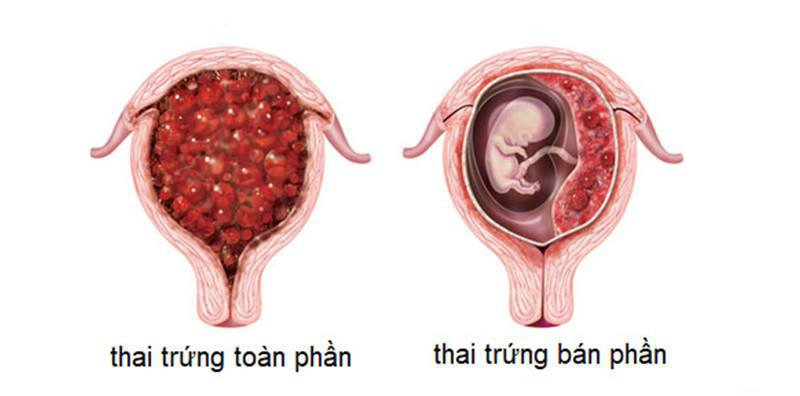 Bị thai trứng