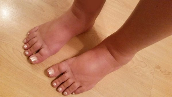 dấu hiệu suy thận giai đoạn đầu