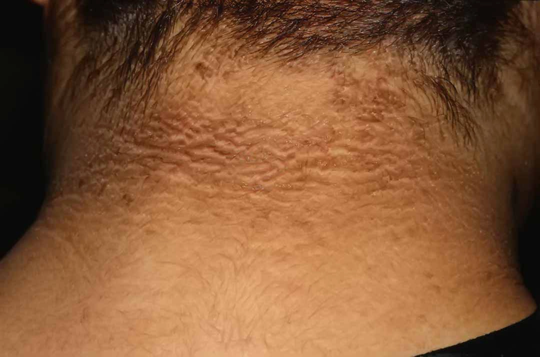 da của người bị tiểu đường
