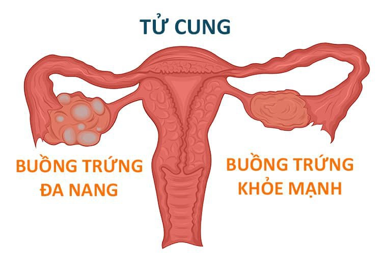 Buồng trứng đa nang