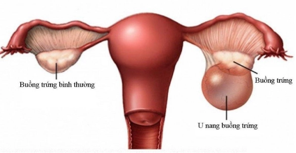 U nang buồng trứng