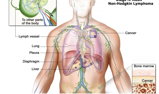 U lympho Non- Hodgkin