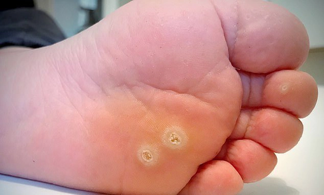các bệnh về lòng bàn chân