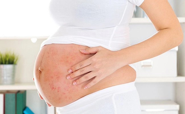 Bà bầu bị tay chân miệng có thể vượt qua bệnh để sinh con