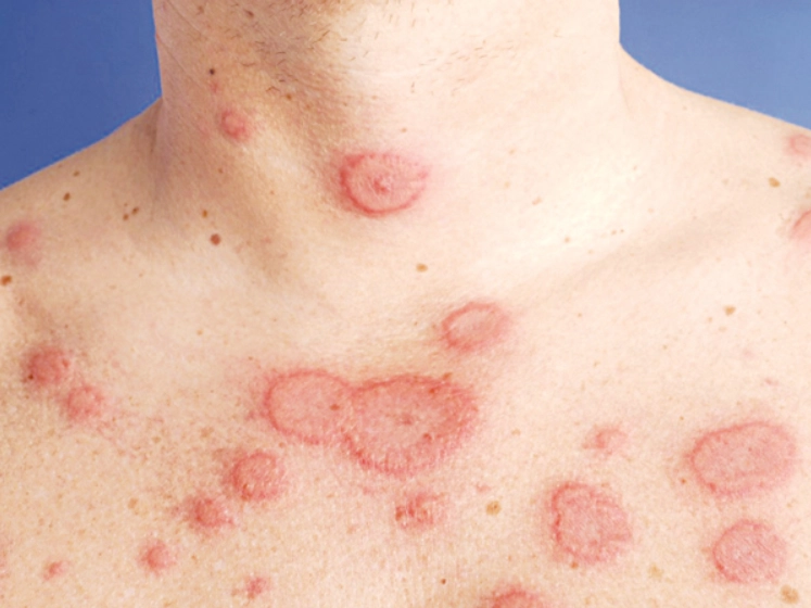 Bệnh lupus ban đỏ dạng đĩa
