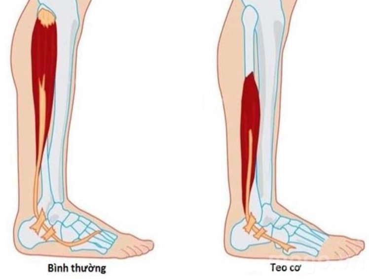 Teo cơ cột sống