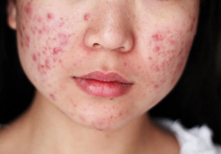 mụn trứng cá
