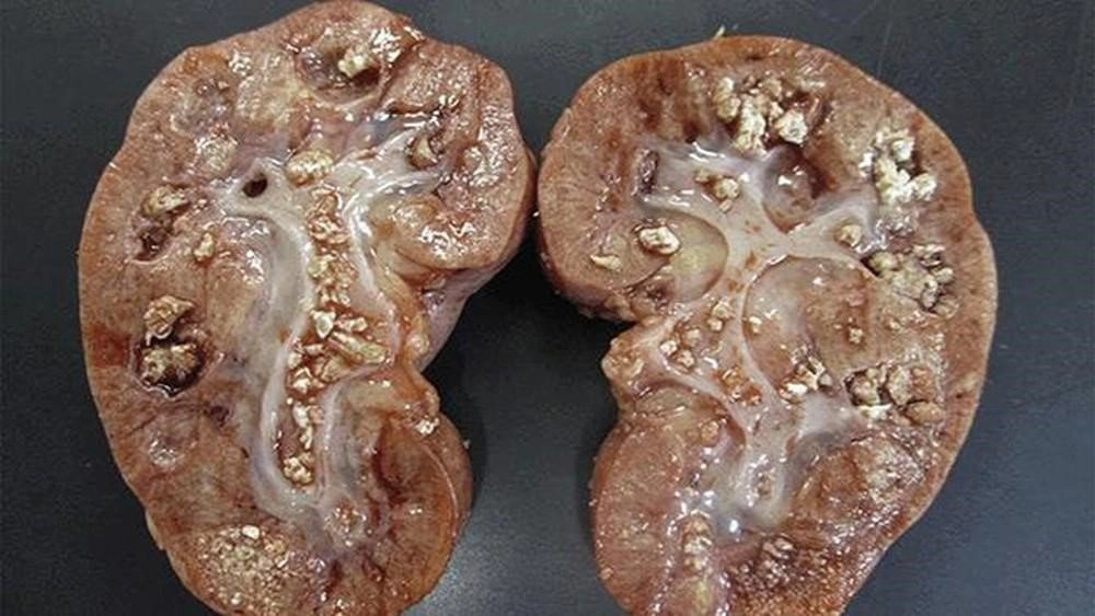 Nguyên nhân gây tiểu buốt có thể do bệnh sỏi thận gây ra
