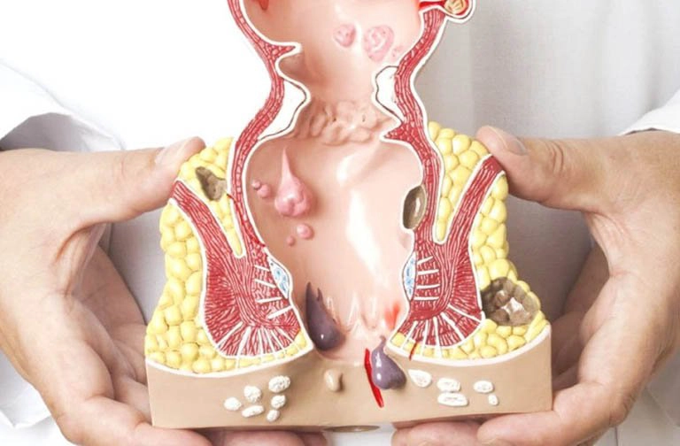 hậu môn bị sưng