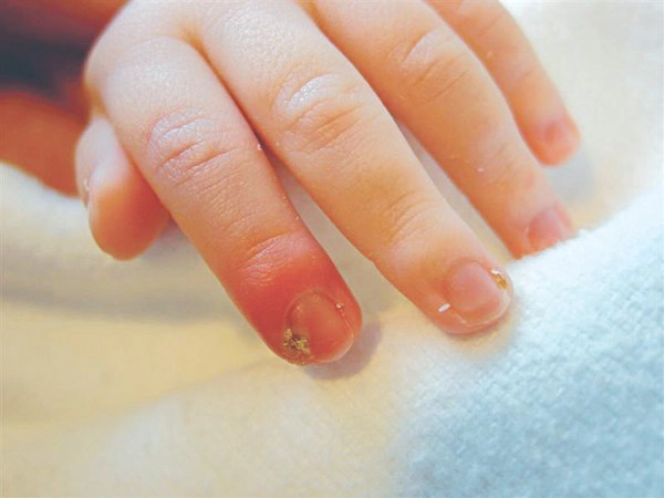Biến chứng của chín mé nếu không điều trị kịp thời