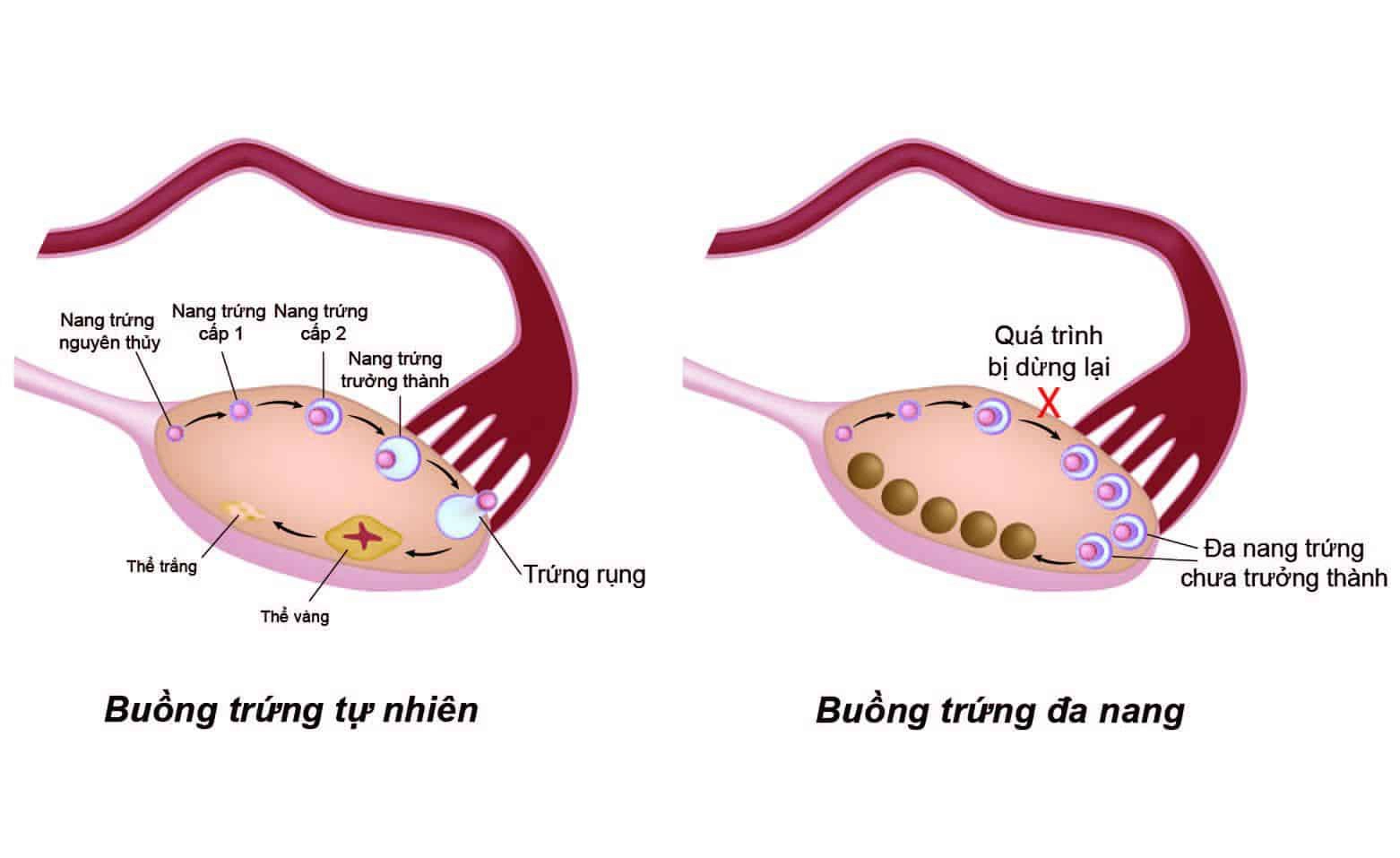 Các tiêu chuẩn chẩn đoán buồng trứng đa nang