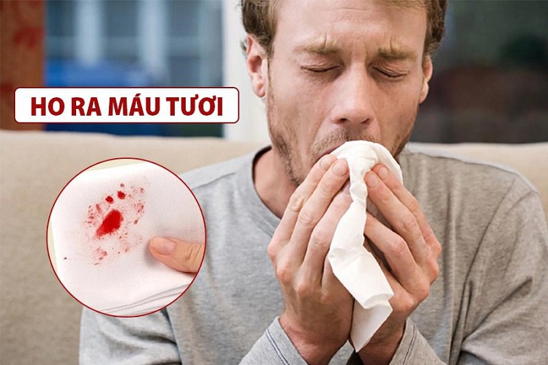 Triệu chứng bệnh lao phổi tái phát