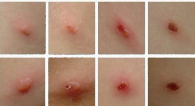 Các triệu chứng thủy đậu