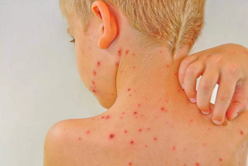 Có nhiều phương pháp để xét nghiệm bệnh thủy đậu và bệnh zona