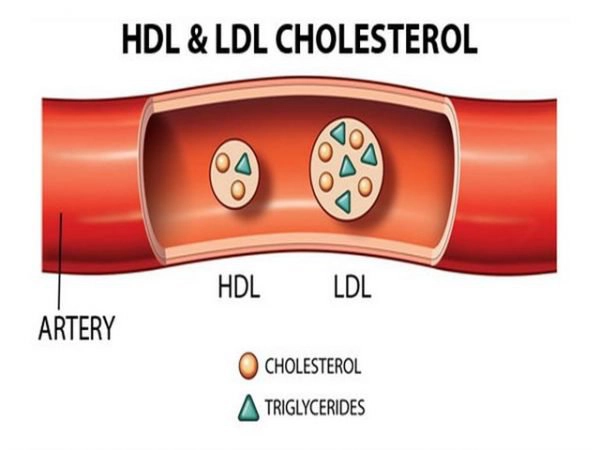 ldl