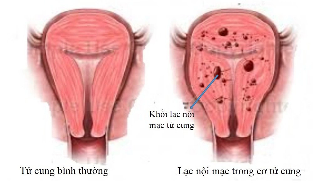 cac-yeu-nguy-co-gay-lac-noi-mac-tu-cung-1