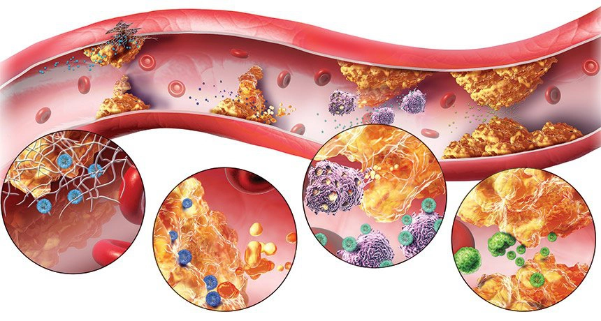 Rối loạn lipid máu, bệnh mỡ máu