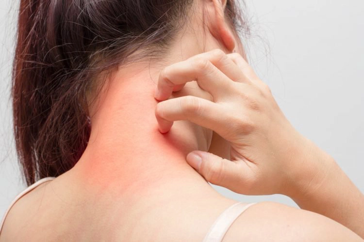 kích ứng là gì