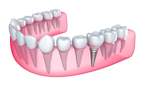 Tác dụng của răng giả