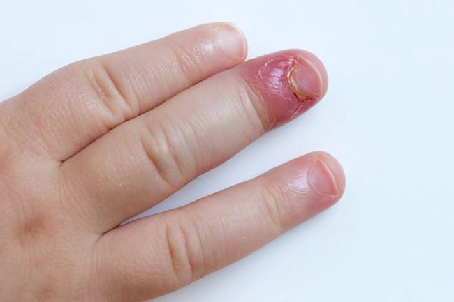 cách chữa chín mé tay có mủ