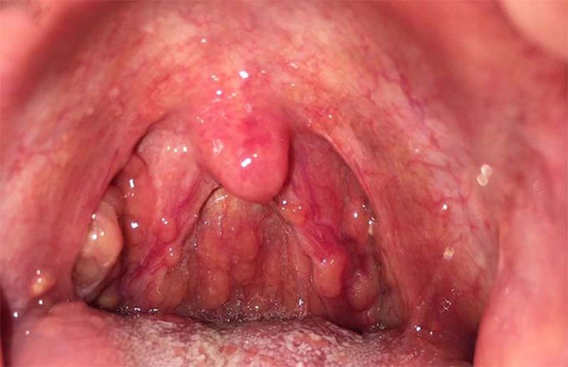 cách chữa viêm họng hạt