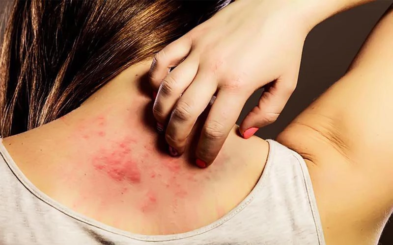 Da bị herpes và vẩy nến gây mẩn ngứa, nên dùng kem dưỡng thế nào?