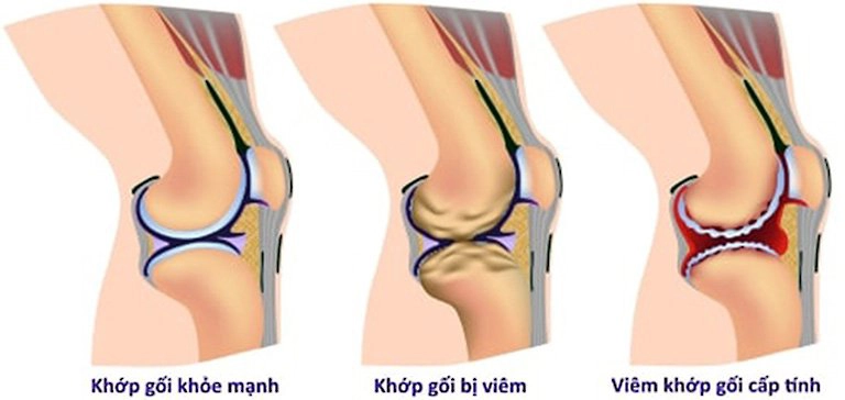 Viêm khớp gối gây đau đớn, phù nề khớp