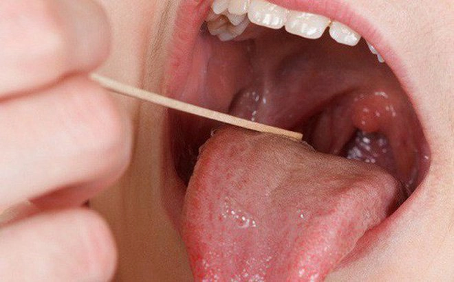 Khi viêm áp-xe amidan gây sốt đau họng bạn nên gặp bác sĩ chuyên khoa