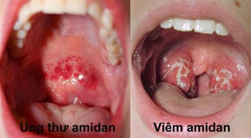 Tình trạng viêm áp-xe amidan cần được chẩn đoán phân biệt với ung thư Amidan
