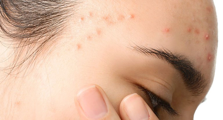cách chữa mụn nhọt
