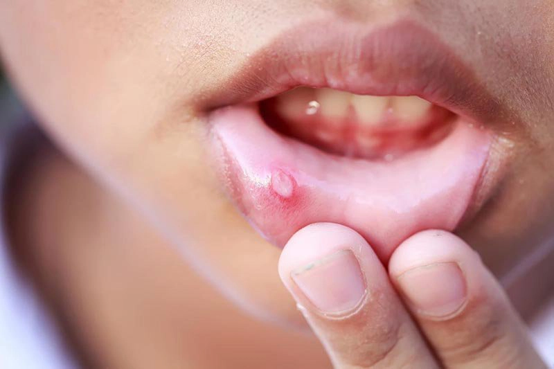 cách trị nhiệt miệng trong 1 ngày