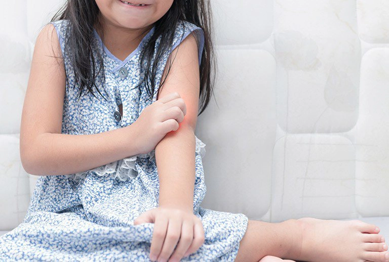 cách trị nổi mề đay cho trẻ