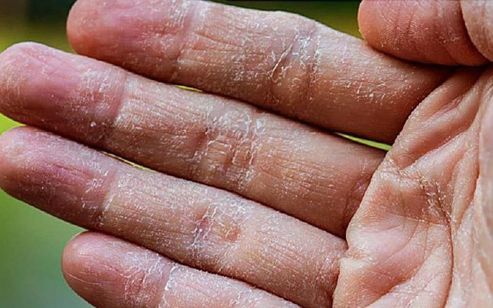 da tay bị tróc