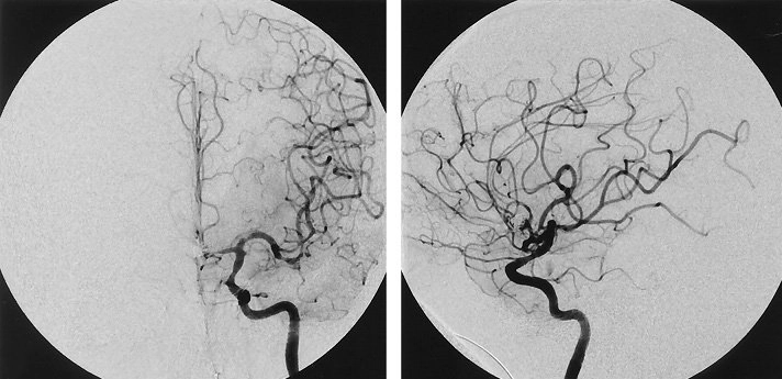 chụp mạch máu số hóa xóa nền (Digital Subtraction Angiography - DSA)