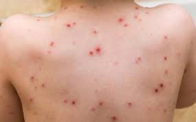 Bệnh thủy đậu và những điều cần biết
