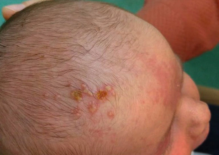 các loại mụn ở trẻ sơ sinh