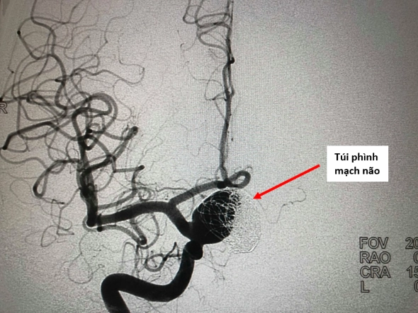 Tình trạng túi phình trước khi đặt stent