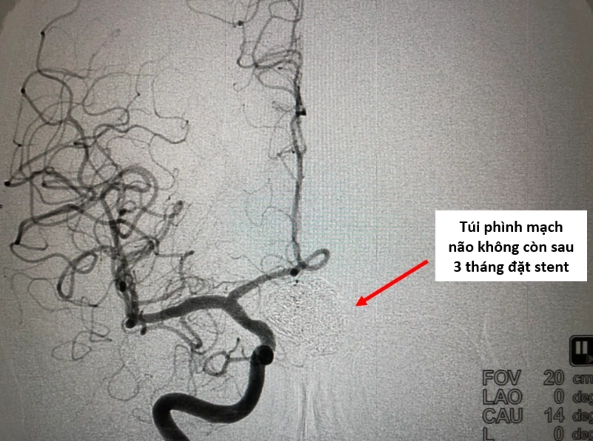 stent